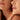 Dermal Fillers