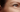 Fine Lines vs Wrinkles: What’s the Difference and How Do You Treat Them